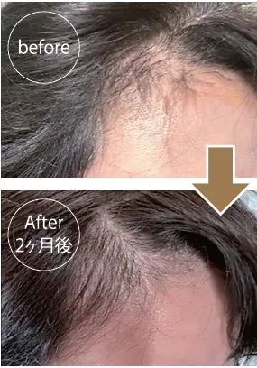 女性モニターの2ヶ月後の頭皮と髪の変化