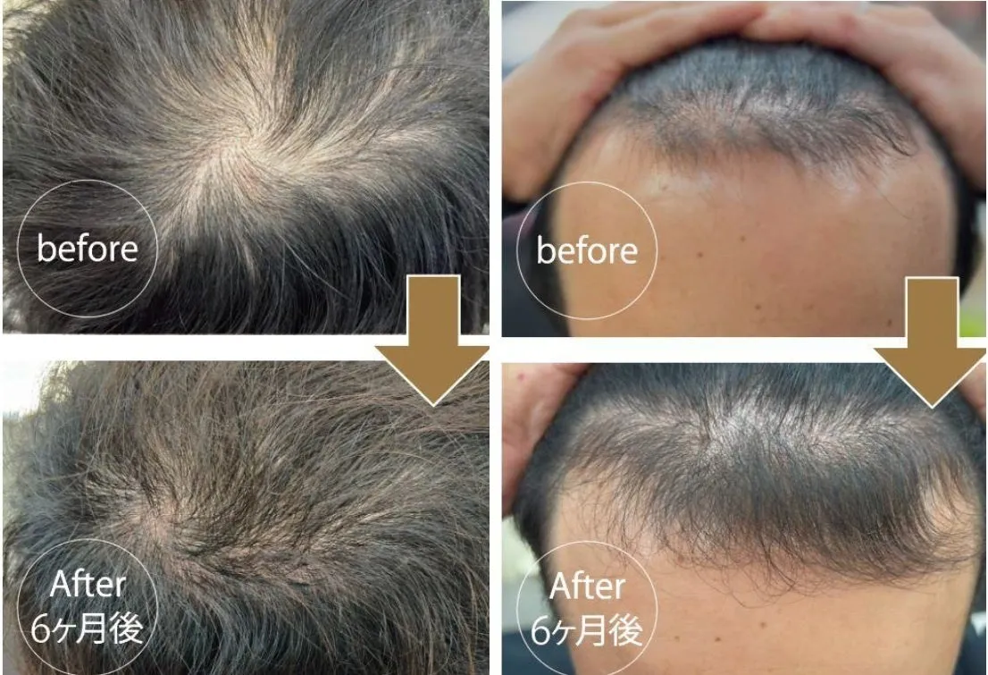男性モニターの6ヶ月後の頭皮と髪の変化